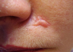 Народные методы лечения коллоидных рубцов Народные методы лечения рубцов