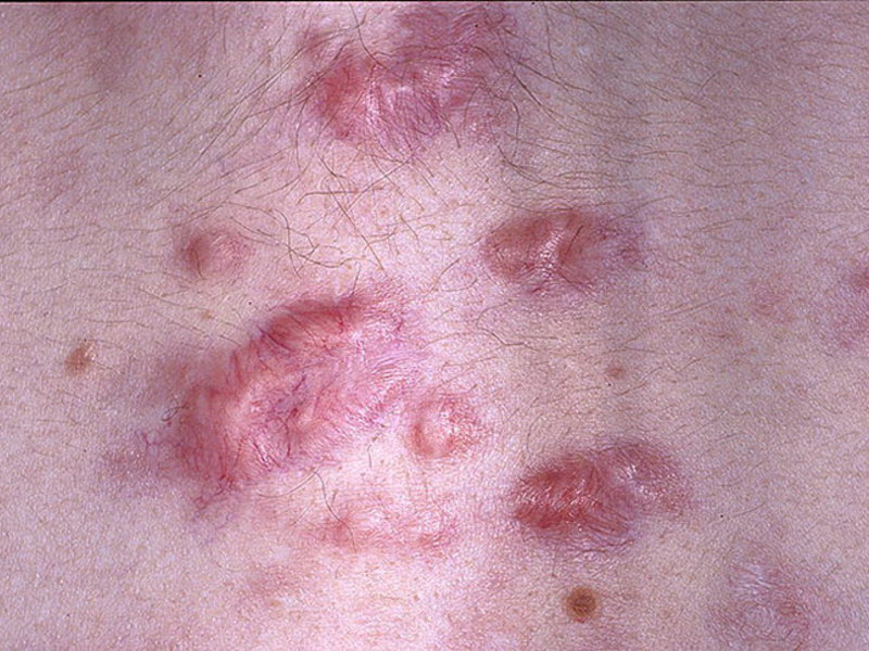 Симптомы коллоидного рубца Какие бывают коллоидные рубцы