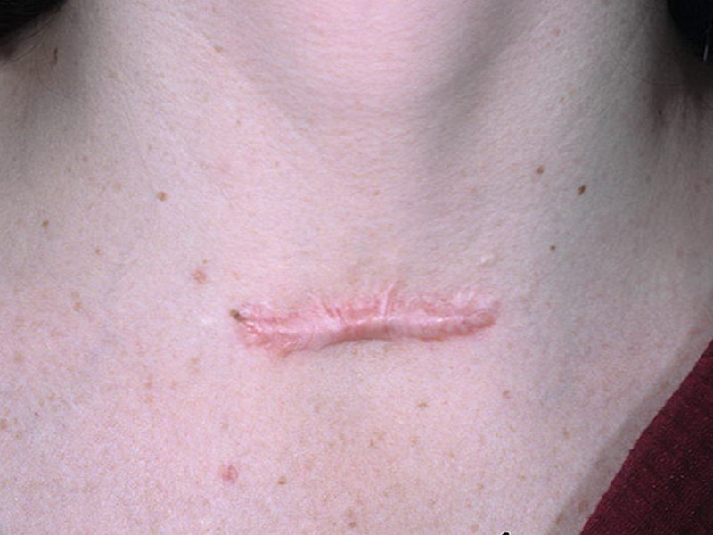 Келоидные рубцы - особенности лечения. Устранение рубца лазером