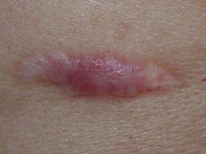 Коллоидные рубцы. Как лечить коллоидные рубцы