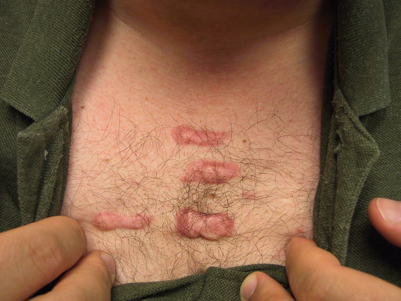 Келоидный рубец. Коллоидный рубец на теле