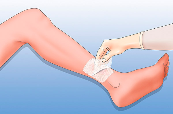Накладывание компрессов при подагре Накладывание компрессов при подагре