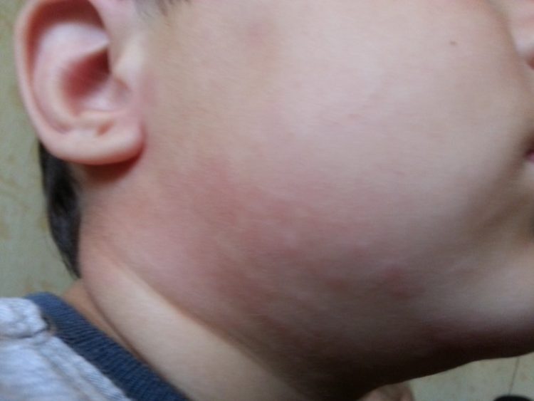 Прыщи как ожог крапивой у ребенка