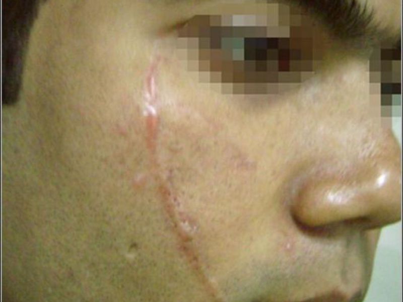 Как вылечить коллоидный рубец Как убрать шрамы и рубцы без операции? .