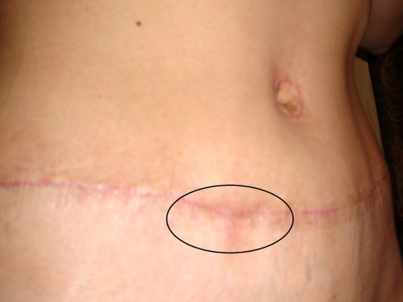 Как устранить коллоидный рубец Устранение коллоидного рубца