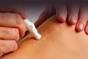 На данный момент используется несколько методов удаления рубцов и шрамов Современные методы лечения рубцов