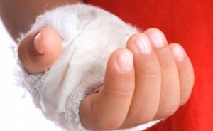 Что можно мазать в волдырь после ожога