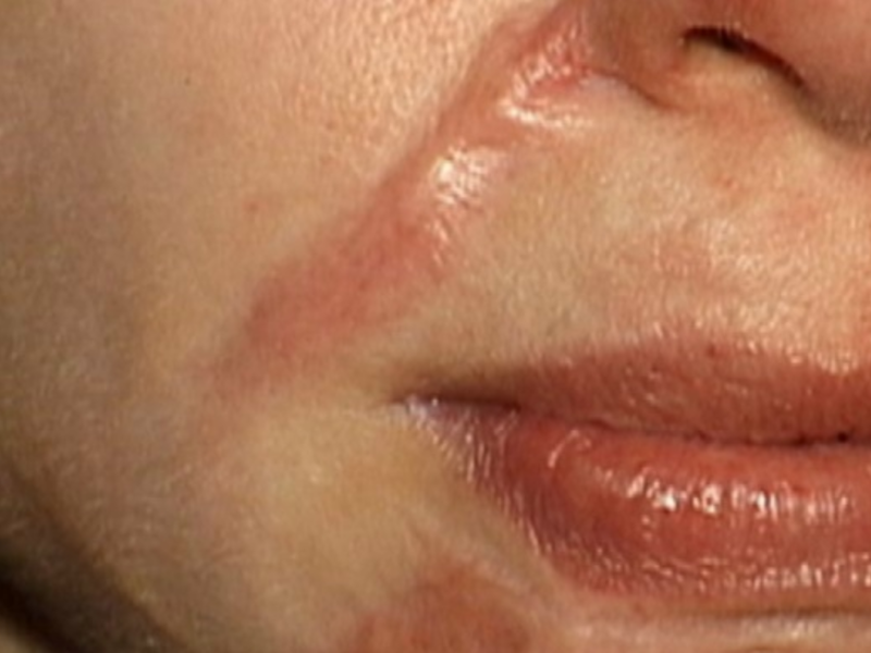 Внешний вид коллоидных рубцов Пластическая операция по удалению коллоидного рубца