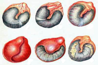 Болезнь на разных стадиях Острый средний катаральный отит