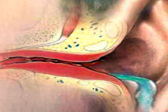 Сужение слухового прохода Проявление болезни