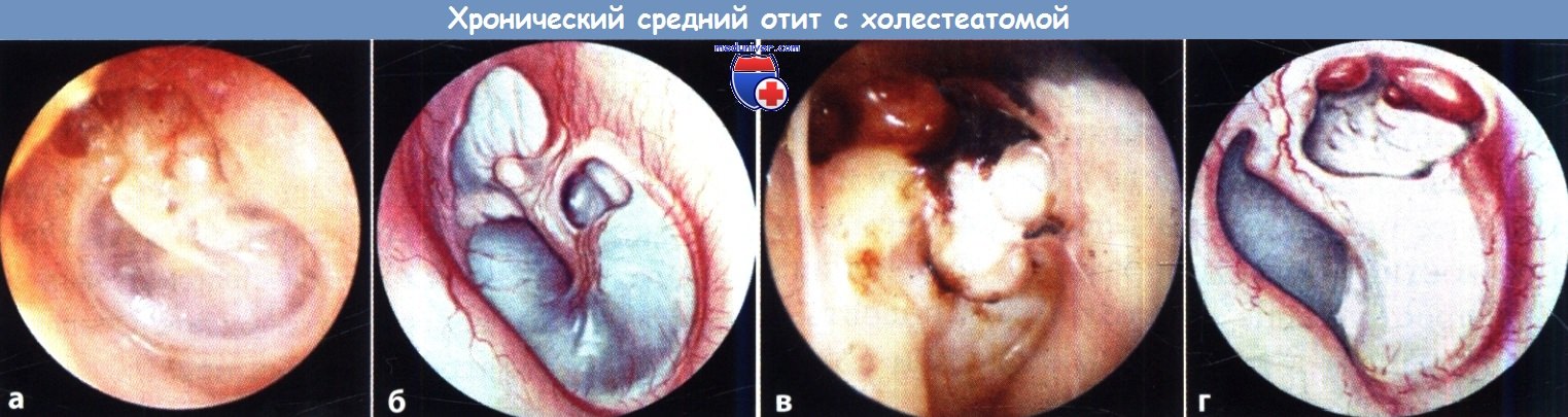 Хронический средний отит с холестеатомой