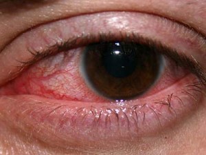 воспаленный глаз воспаленный глаз