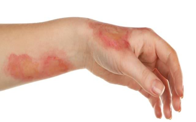 Ожог белый налет в ране