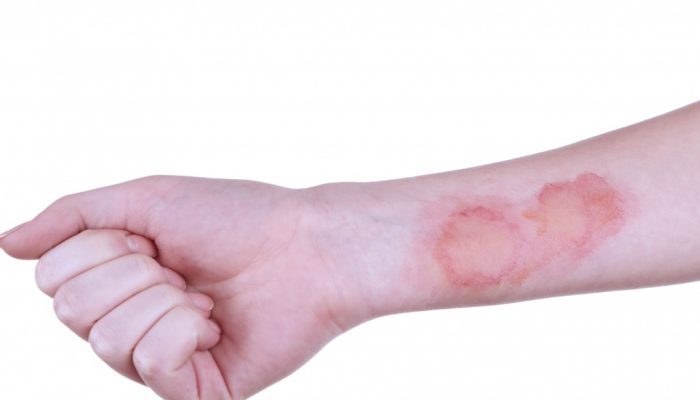 Ожог белый налет в ране