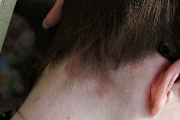 Чем лечить кожу от ожогов после окрашивания
