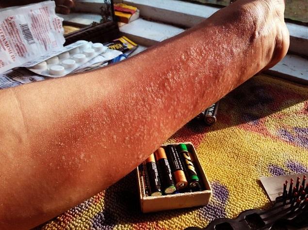 Симптомы ожога Симптомы ожога