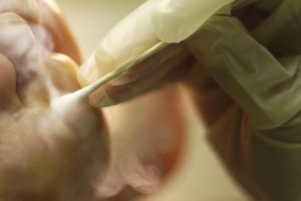 Ожоги от азота на лице