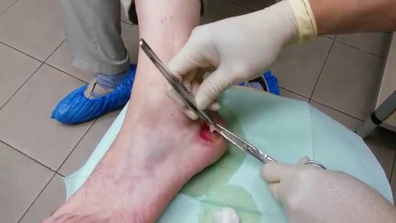 Рассечение ожогового пузыря Рассечение ожогового пузыря