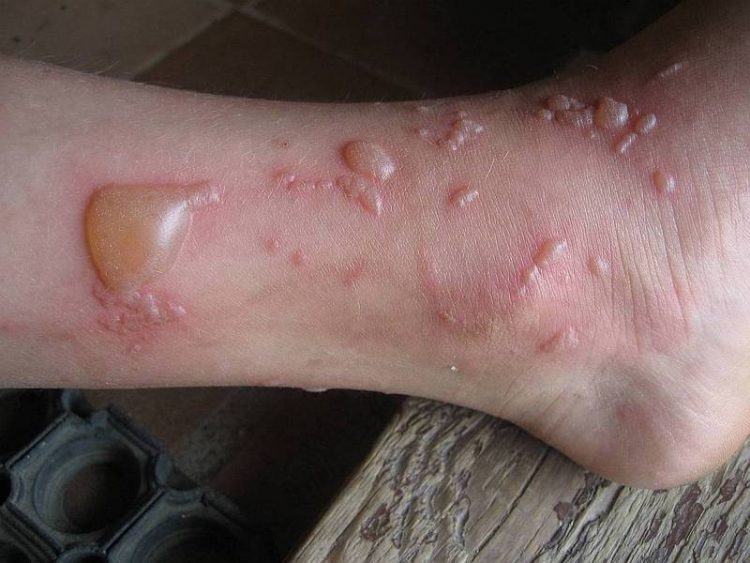 Как быстро убрать пузырь от ожога