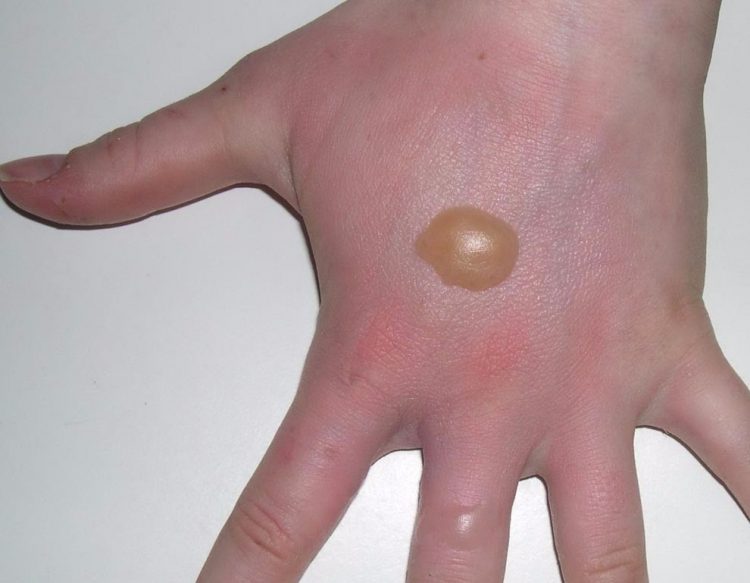 Как быстро убрать пузырь от ожога