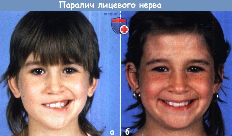 Паралич лицевого нерва