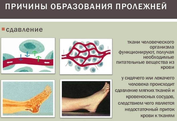 Пластыри от пролежней для лежачих больных. Названия, инструкция, цена, отзывы