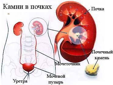 Отложение солей в почках Отложение солей в почках