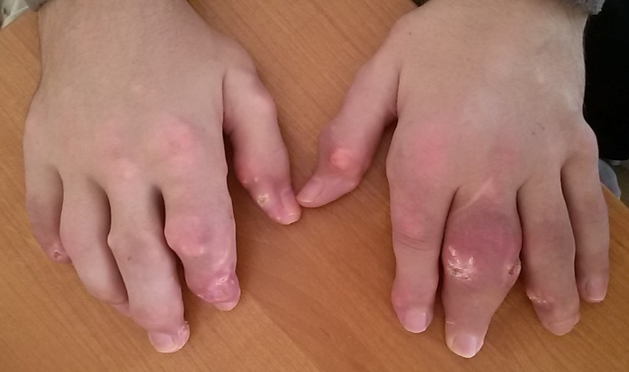 Подагра до лечения