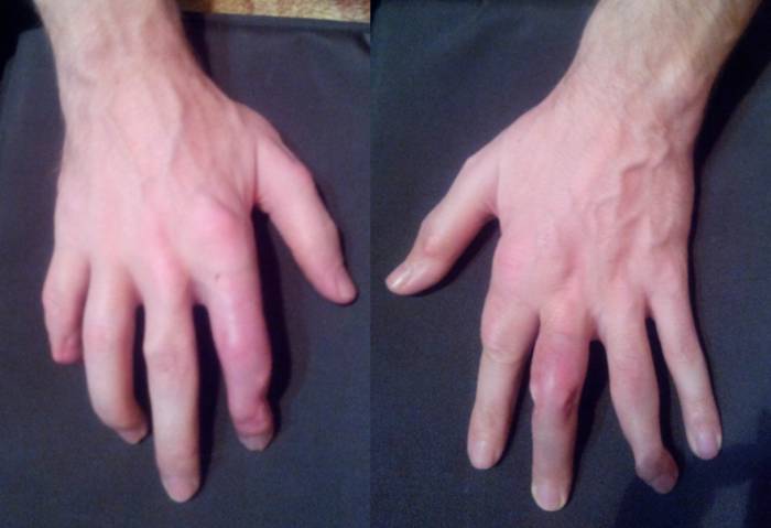 Подагра после лечения