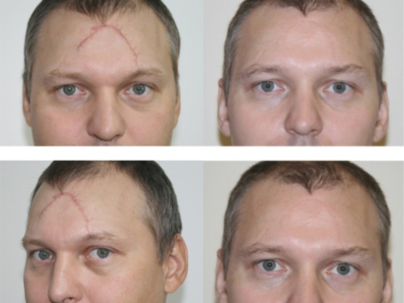 После лучения коллоидного рубца Методы избавления от рубцов