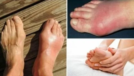 Причины, симптомы подагры, как снять боль Боли при подагре