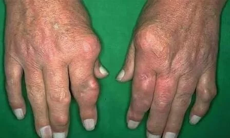 Хроническая подагра Подагра снять боль в домашних условиях