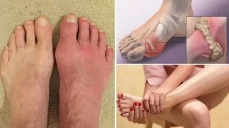 Симптомы подагры Подагра снять боль в домашних условиях