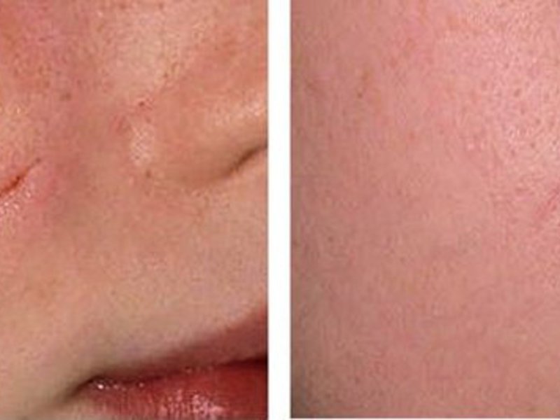 Рубец - последствия осложненной регенерации кожного покрова. . Лечение коллоидного рубца криотерапией.