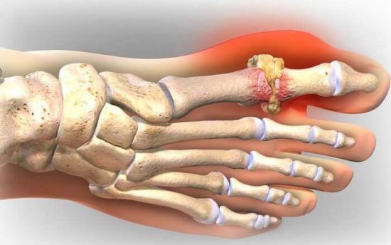 Соли на суставе пальца