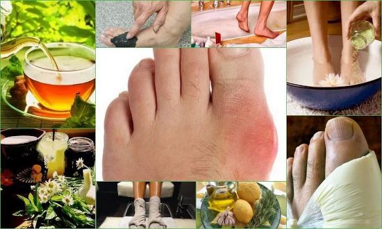 Народные средства от подагры