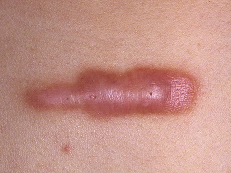 Келоидные рубцы: причины появления и способы лечения Как можно вылечить коллоидный рубец