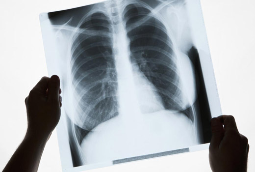 рентгеновский снимок легкого