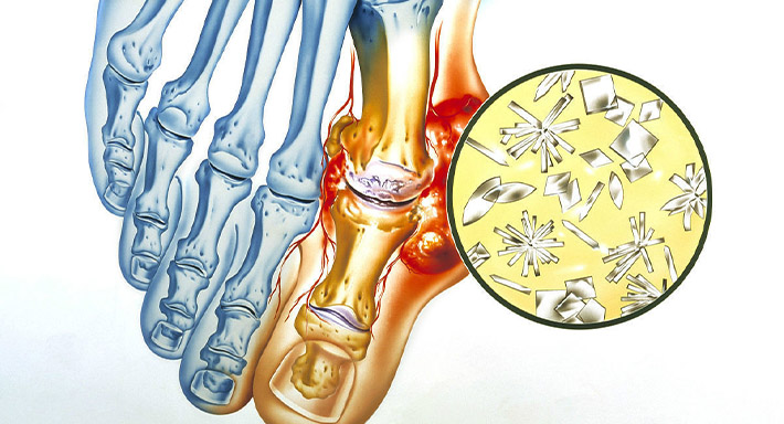 Подагра ног как и чем лечить