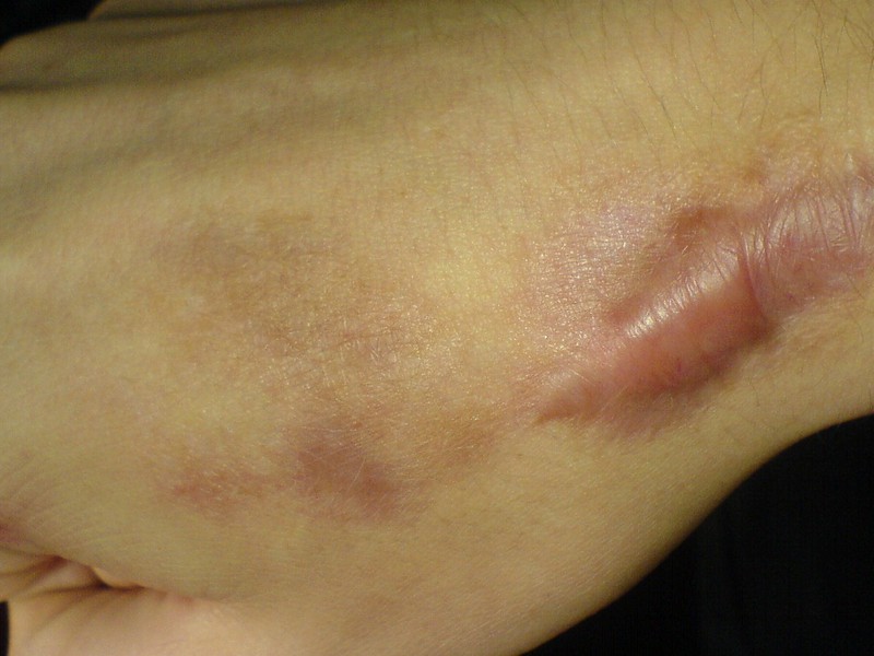 Как удаляют коллоидные рубцы Процедура по лечению келоидных рубцов