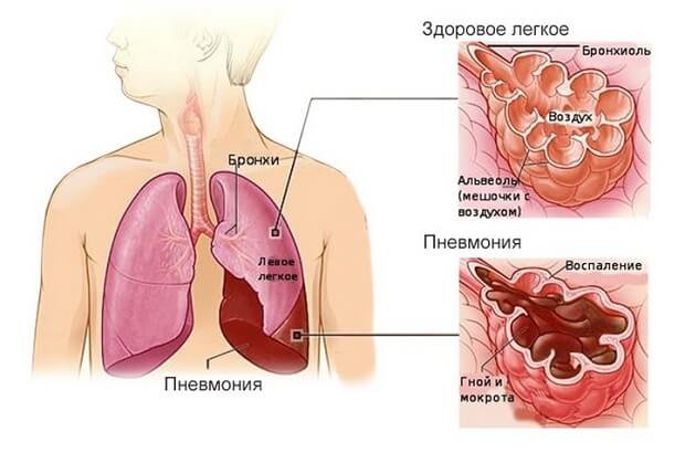 Гнойная мокрота