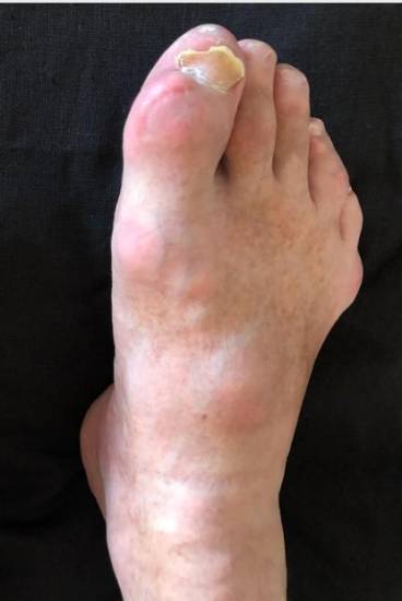 Подагра на ногах в москве