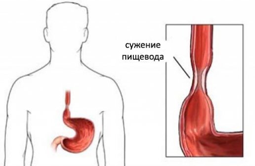 Осложнения при химических ожогах пищевода и желудка