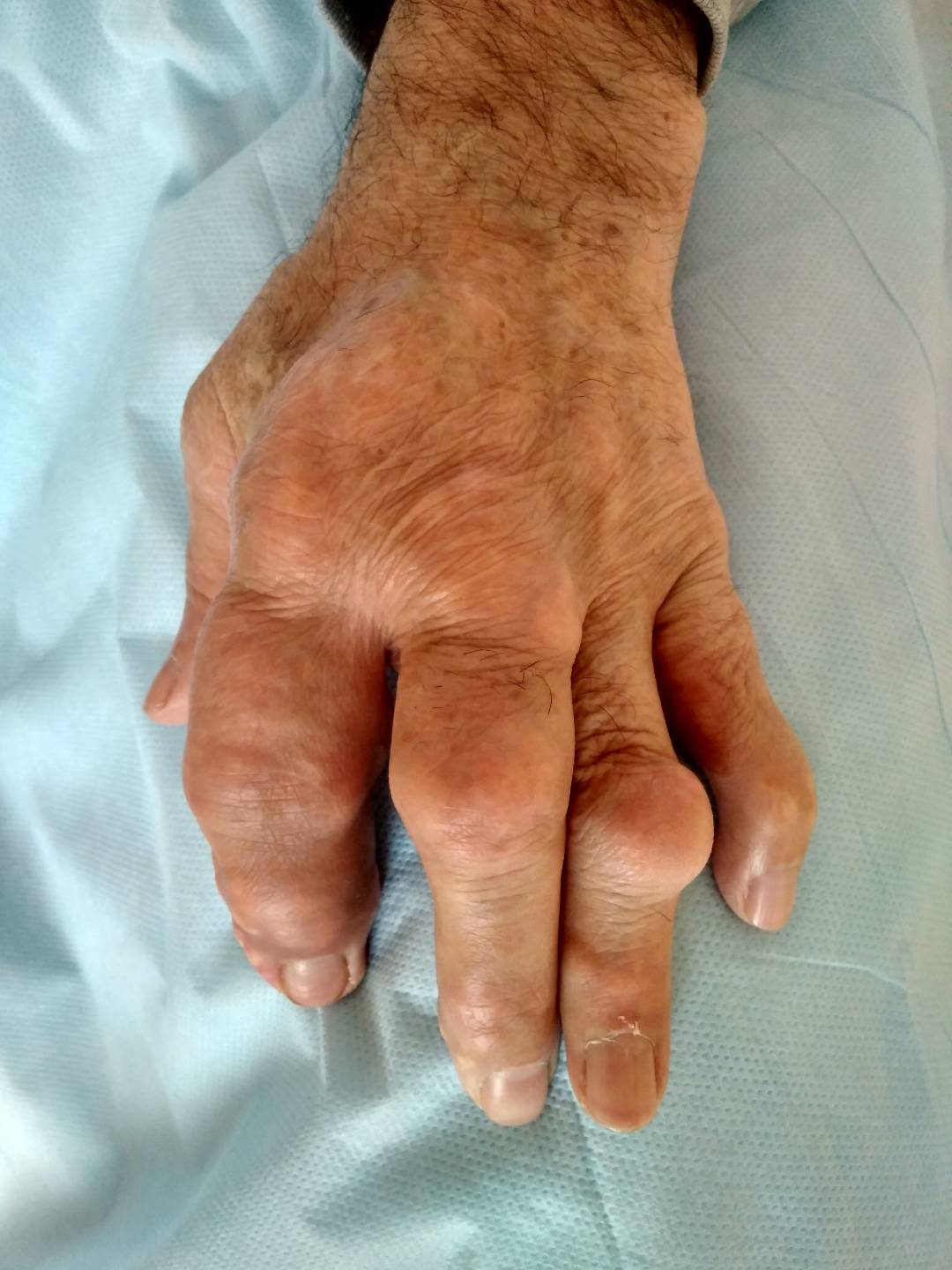 Тофусы-крупные отложения солей мочевой кислоты