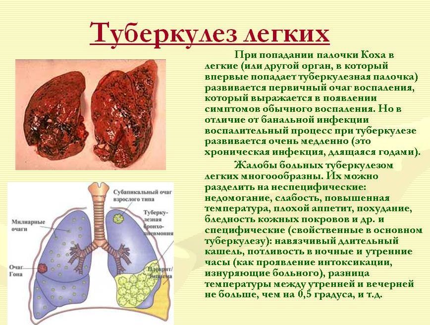 Туберкулез