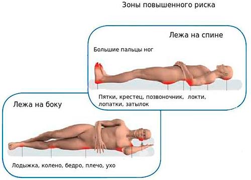 Матрасы от пролежней инструкция к применению