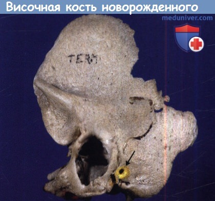 Височная кость новорожденного