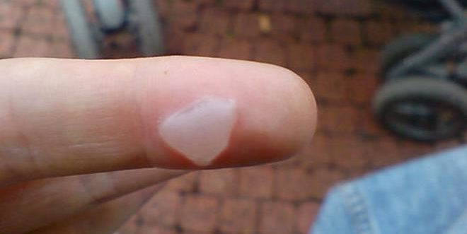 Если обожгли пальцы рук - что делать, как лечить, какие средства применять и чего делать нельзя Если обожгли пальцы рук - что делать, как лечить, какие средства применять и чего делать нельзя