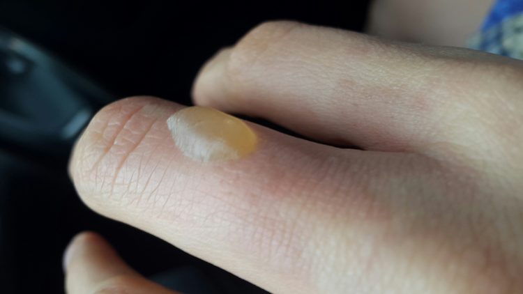 Как быстро убрать пузырь от ожога